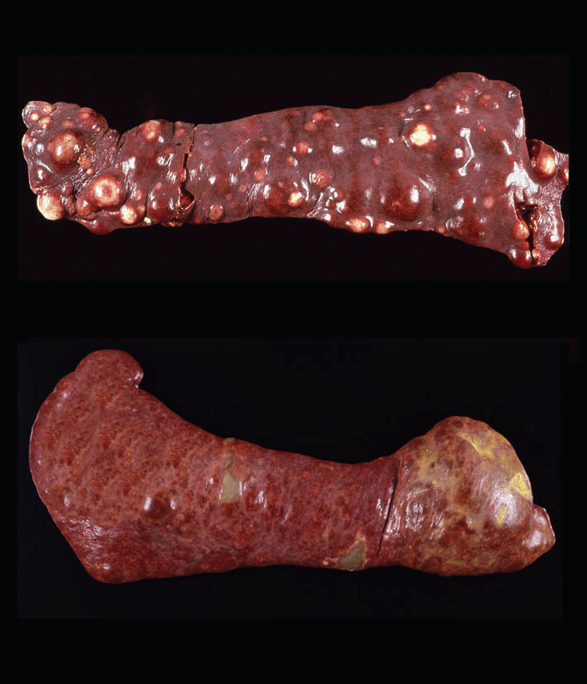 Fig. 1. The two patterns of HS in the spleen: Top - discrete masses (histiocytes with iDC differentiation). Bottom - diffuse splenomegaly in hemophagocytic HS (histiocytes with macrophage differentiation).