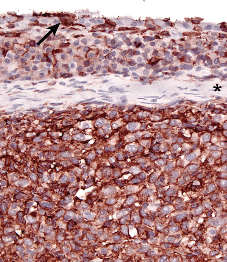 Fig. 8. Articular/Peri-articular HS. Intact synovial lining (arrow - CD18+ type A cell); subsynovial plasma cell rich infiltrate (CD18-); diffuse CD18 expression in HS beneath the fibrous band (*) 