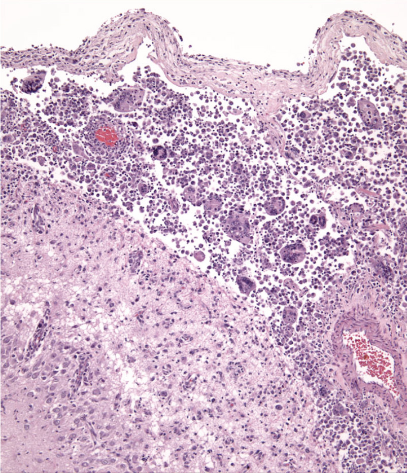 Fig. 9. Cerebral cortex - HS - pleocellular infiltrate in the leptomeninges.