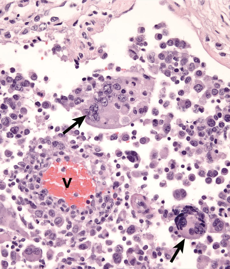 Fig. 10. Cerebral cortex - HS - Lympho-histiocytic infiltrate with atypical multi-nucleated histiocytes (arrows). The vessel wall (v) is infiltrated by histiocytes and lymphocytes.