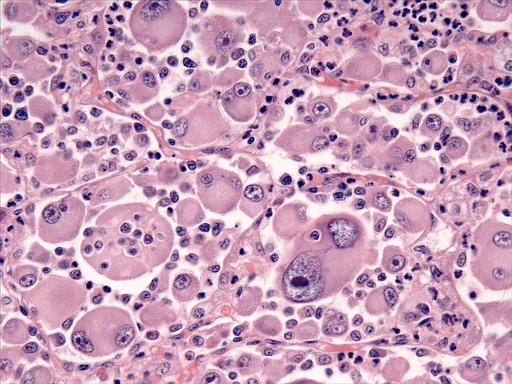 Fig. 2. Pulmonary HS: alveolar spaces filled by atypical histiocytes, which manifest anisocytosis and anisokaryosis; single and multiple nuclei; and prominent phagocytosis of reactive cells.