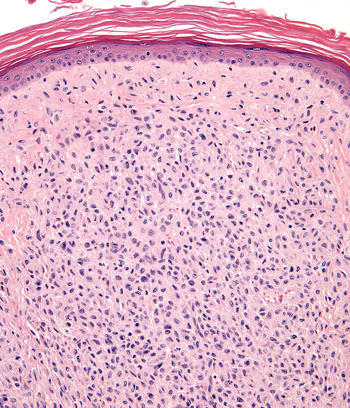 Fig. 2. FPH. Bland dermal histiocytic infiltrate
