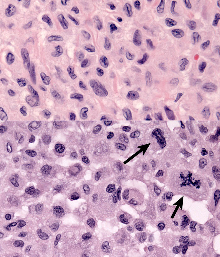Fig. 3. FPH. Histiocytes have moderate anisokaryosis and convoluted nuclear profiles with minimal atypia (upper). Contrast this with the cytological atypia and malformed mitotic figure (arrows - lower). 
