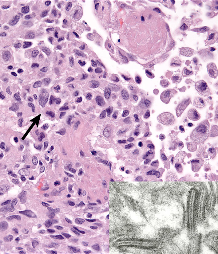 Fig. 4. pLCH - Lung - Histiocytes form cohesive sheets (arrow) and have complex nuclear profiles; inset Birbeck’s granules (TEM). 