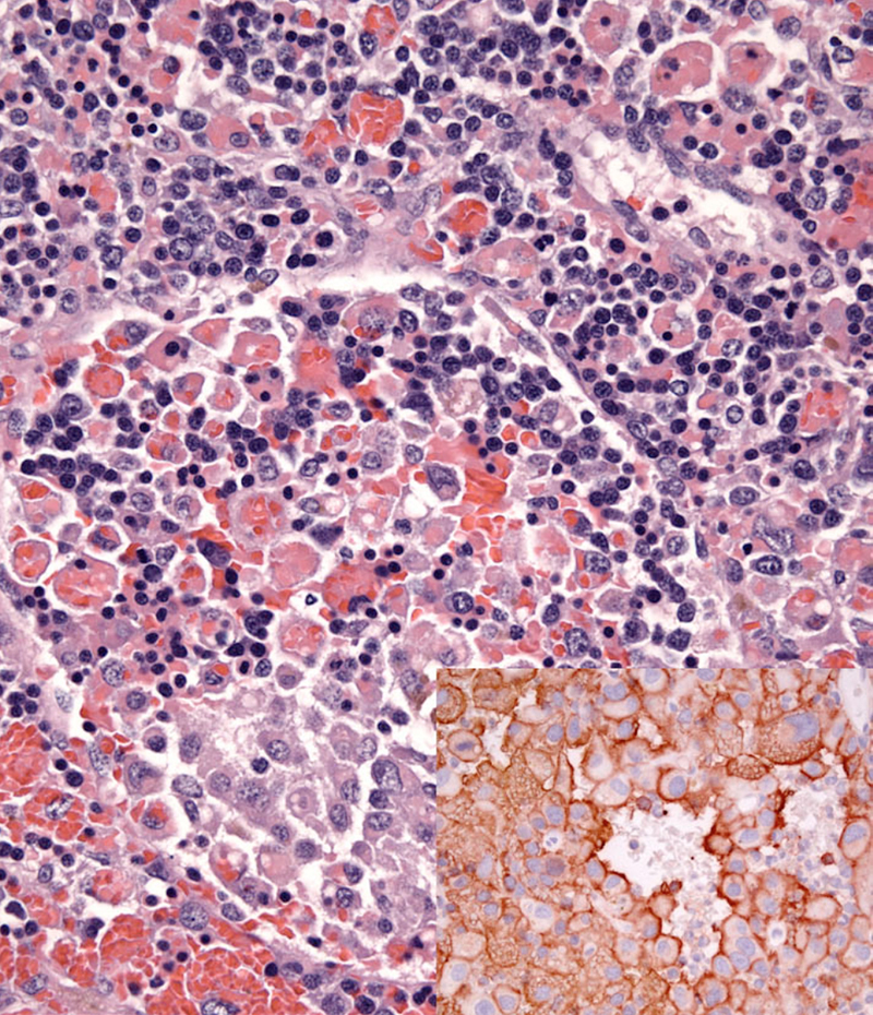 Fig. 2. Hemophagocytic HS red pulp sinus invasion by histiocytes, which area accompanied by EMH. Inset: CD11d