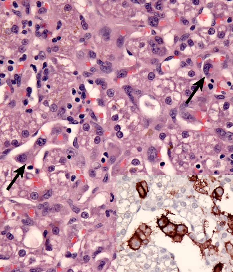 Fig. 3. Hemophagocytic HS - invasion of hepatic sinusoids by erythrophagocytic histiocytes. Inset: CD11d 