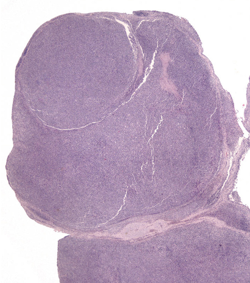 Fig. 6. Articular/Peri-articular HS - Multinodular growth pattern - bulging into the synovial space.