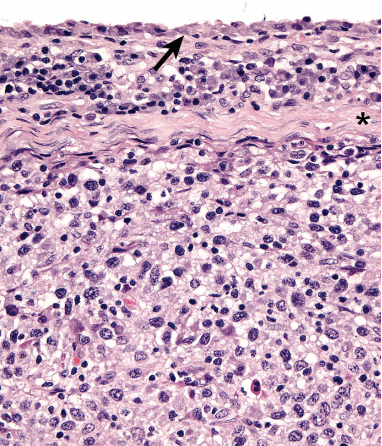 Fig. 7. Articular/Peri-articular HS - Intact synovial lining (arrow); subsynovial plasma cell rich infiltrate; HS is beneath the fibrous band (*)